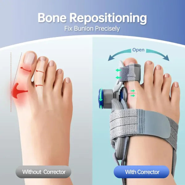 BunioFit Bunion Correctors AU2
