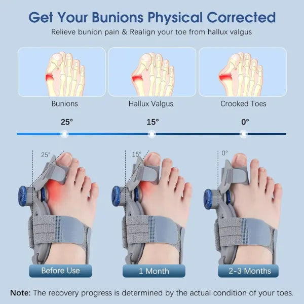 BunioFit Bunion Correctors AU2